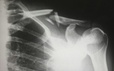 Pilot use case: Bone Fracture AI